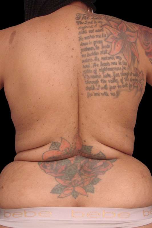 Back Lift/Tuck Before & After Patient #1928