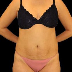Umbilicoplasty Before & After Patient #1950