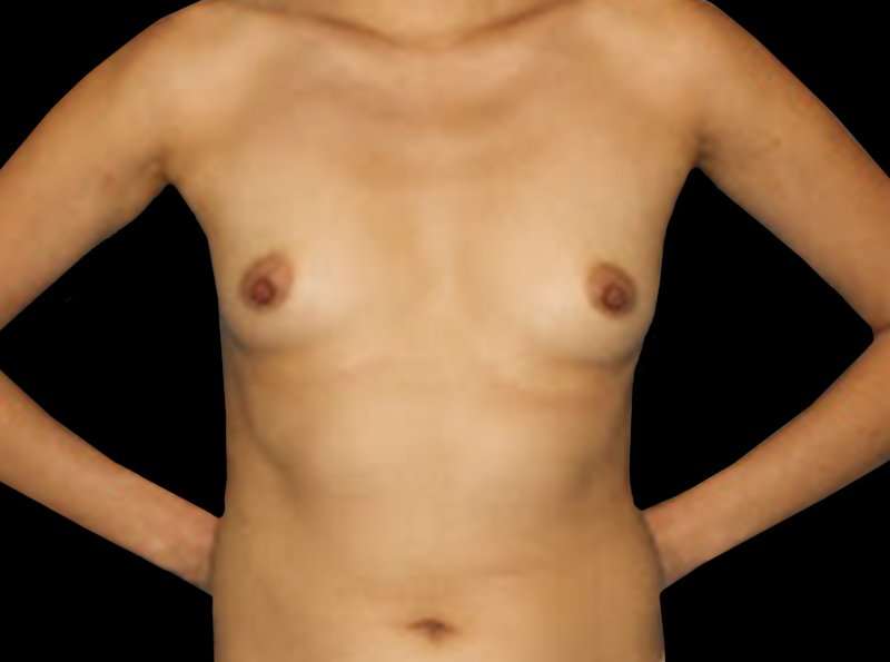 Breast Augmentation w/ Fat Transfer Before & After Patient #1971