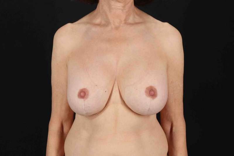 Breast Augmentation w/ Fat Transfer Before & After Patient #1993
