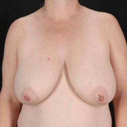 Breast Augmentation w/ Fat Transfer Before & After Patient #2016