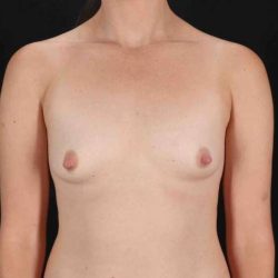 Breast Augmentation w/ Fat Transfer Before & After Patient #2027