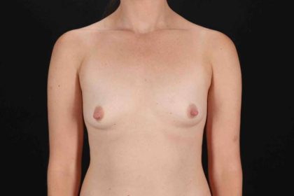 Breast Augmentation w/ Fat Transfer Before & After Patient #2027