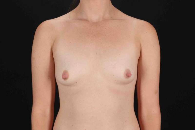 Breast Augmentation w/ Fat Transfer Before & After Patient #2027