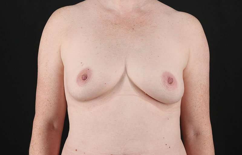 Breast Augmentation w/ Fat Transfer Before & After Patient #2038