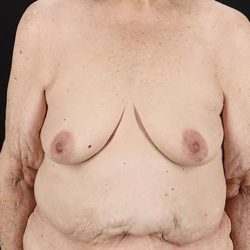 Breast Augmentation w/ Fat Transfer Before & After Patient #2049
