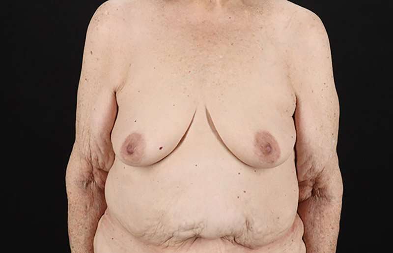 Breast Augmentation w/ Fat Transfer Before & After Patient #2049
