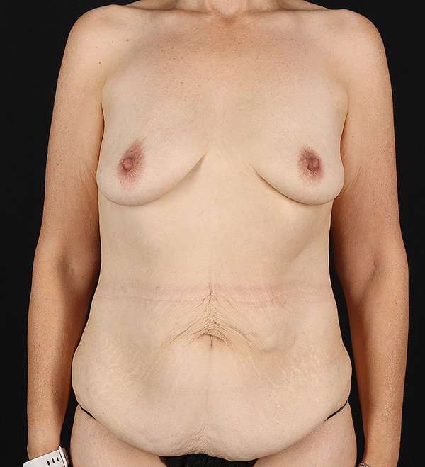 Breast Augmentation w/ Fat Transfer Before & After Patient #2088