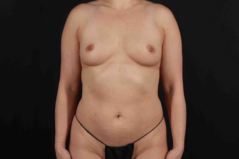 Breast Augmentation w/ Fat Transfer Before & After Patient #2099