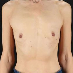 Breast Augmentation Before & After Patient #2110