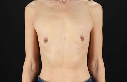 Breast Augmentation Before & After Patient #2110