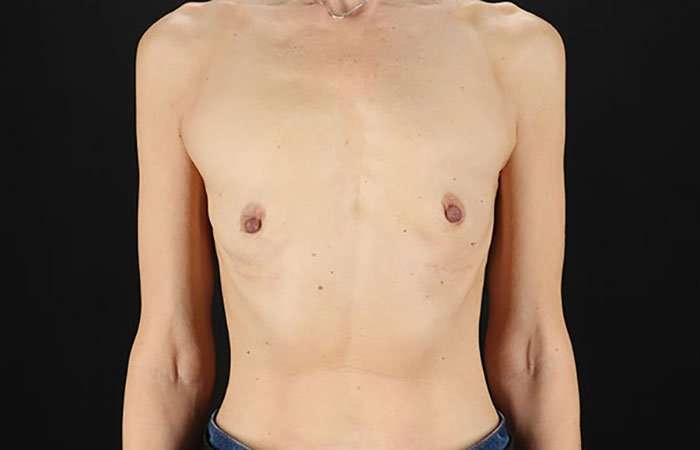 Breast Augmentation Before & After Patient #2110