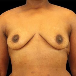 Breast Augmentation Before & After Patient #2121