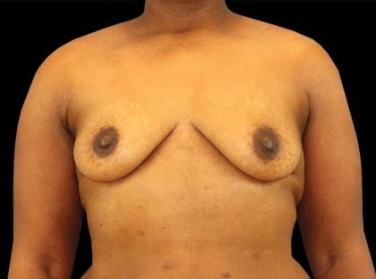 Breast Augmentation Before & After Patient #2121