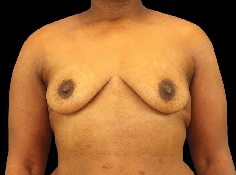 Breast Augmentation Before & After Patient #2121