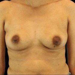 Breast Augmentation Before & After Patient #2129