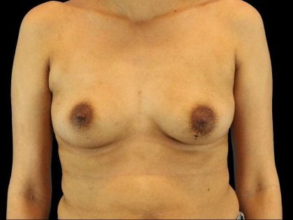 Breast Augmentation Before & After Patient #2129