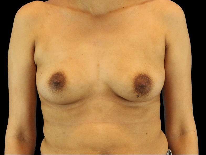Breast Augmentation Before & After Patient #2129