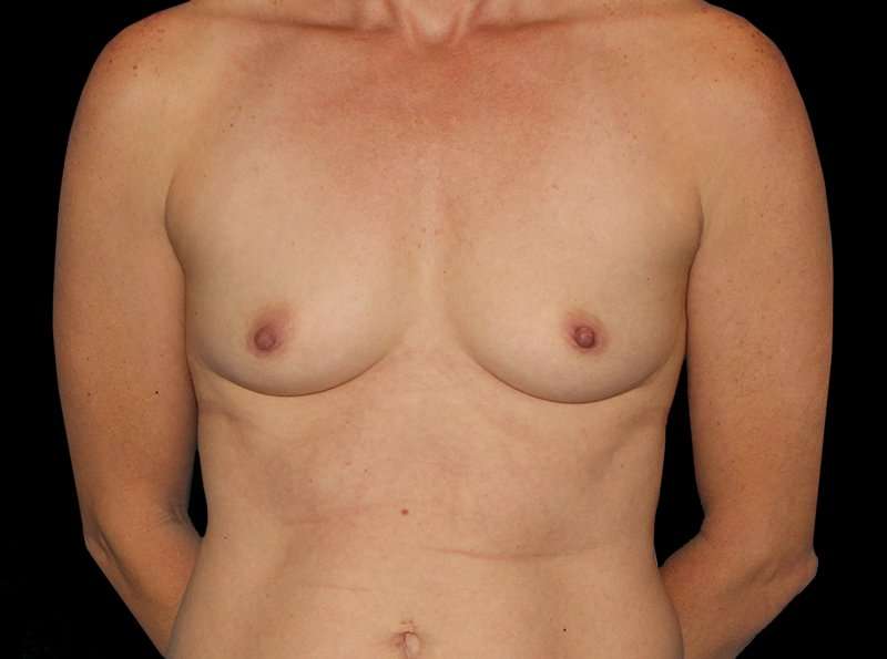 Breast Augmentation Before & After Patient #2136