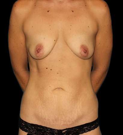 Breast Augmentation Before & After Patient #2147
