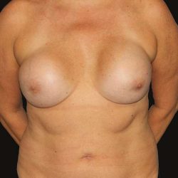 Breast Augmentation Before & After Patient #2157