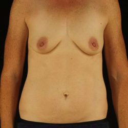 Breast Augmentation Before & After Patient #2178