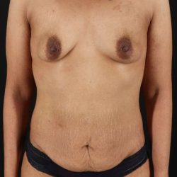Breast Augmentation Before & After Patient #2186