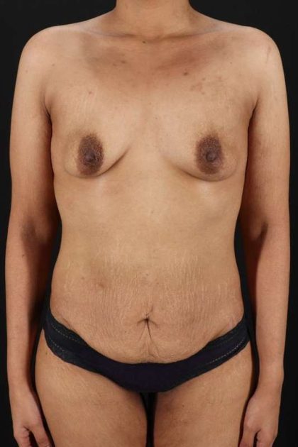 Breast Augmentation Before & After Patient #2186