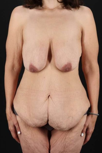 Breast Augmentation Before & After Patient #2207
