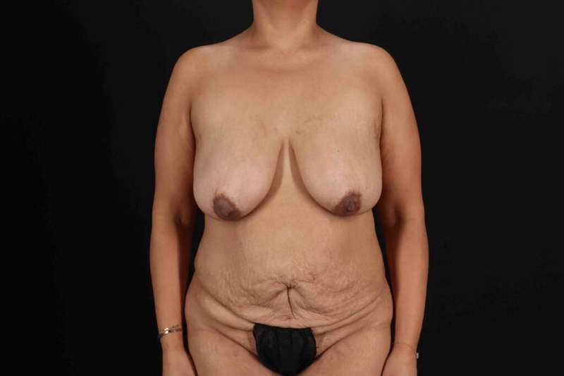 Abdominoplasty (Tummy Tuck) Before & After Patient #733