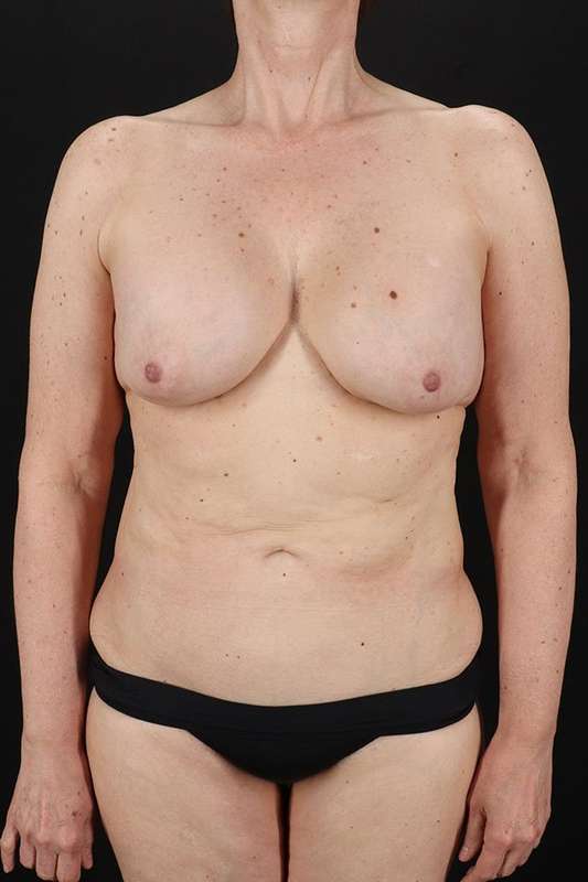 Breast Augmentation Before & After Patient #2263