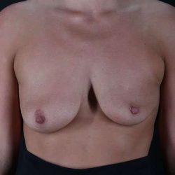 Breast Augmentation Before & After Patient #2281