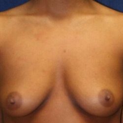 Breast Augmentation Before & After Patient #2291