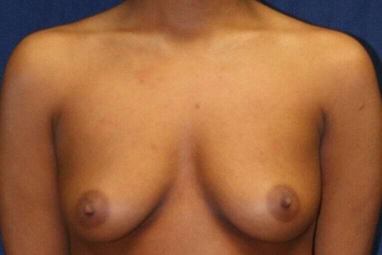 Breast Augmentation Before & After Patient #2291