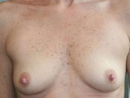 Breast Augmentation Before & After Patient #2302