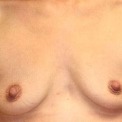 Breast Augmentation Before & After Patient #2318