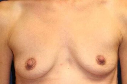 Breast Augmentation Before & After Patient #2318