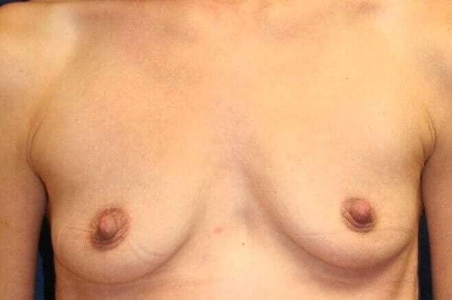 Breast Augmentation Before & After Patient #2318
