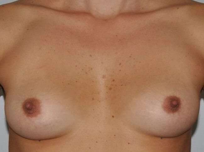 Breast Augmentation Before & After Patient #2323