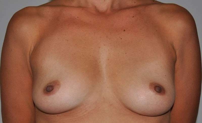 Breast Augmentation Before & After Patient #2326