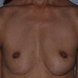Breast Augmentation Before & After Patient #2329