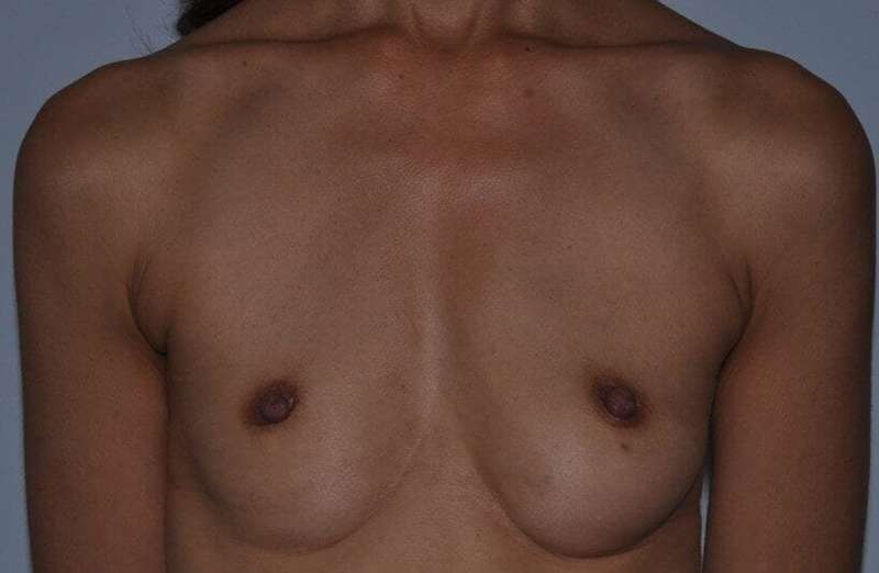 Breast Augmentation Before & After Patient #2329