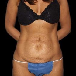 Abdominoplasty (Tummy Tuck) Before & After Patient #757