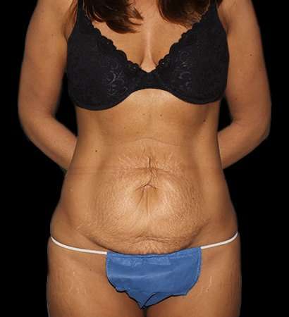 Abdominoplasty (Tummy Tuck) Before & After Patient #757