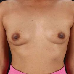 Breast Augmentation Before & After Patient #2354