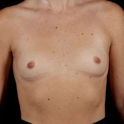 Breast Augmentation Before & After Patient #2365