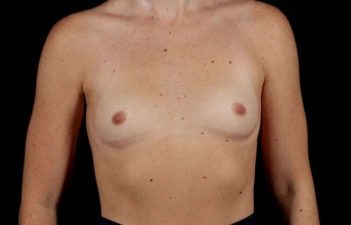 Breast Augmentation Before & After Patient #2365
