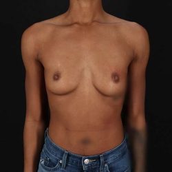 Breast Augmentation Before & After Patient #2376
