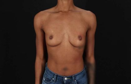 Breast Augmentation Before & After Patient #2376