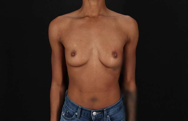 Breast Augmentation Before & After Patient #2376